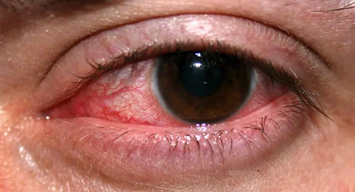 Detección de enfermedades oculares con un smartphone