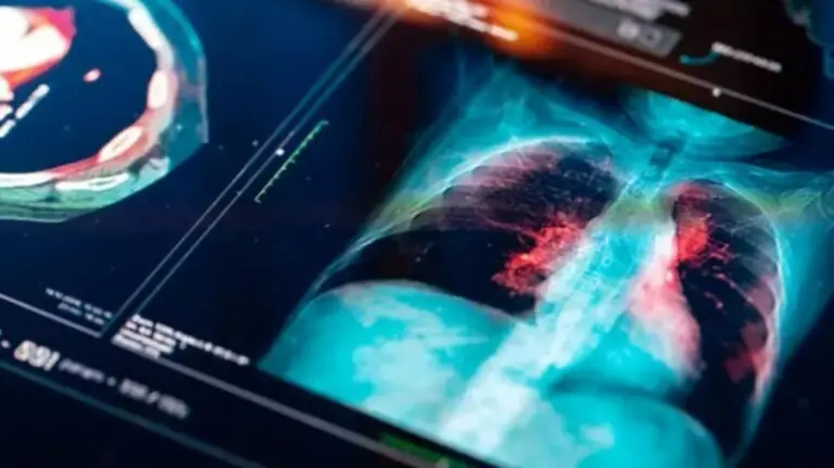 Logran predecir el riesgo de cáncer de pulmón a través de inteligencia artificial