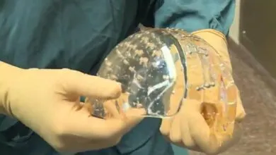 Impresión 3D salva la vida de un niño bávaro con un implante craneal